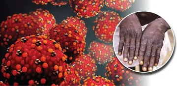 Маймунската шарка се доказва с изследване