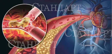 Този лош, лош холестерол...Какво да ядем, за да се предпазим?