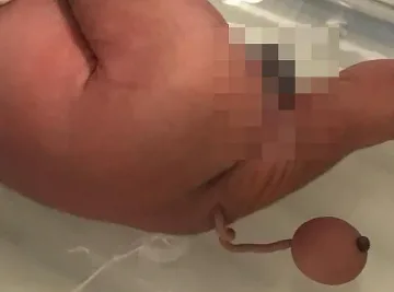 Аномалия! Роди се бебе с 12 см опашка