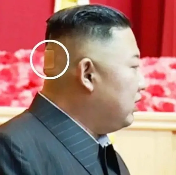 Догадки за раната на главата на Ким Чен Ун