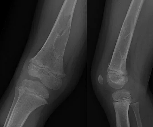 Уникална операция! Поставиха мегапротеза на дете