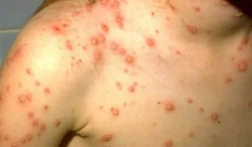 Иде нов тип скарлатина