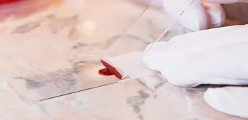 До какво води ранното откриване на рак на кожата