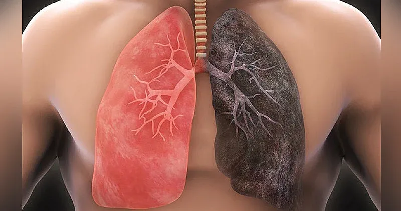 Защо и непушачи се разболяват от белодробен рак