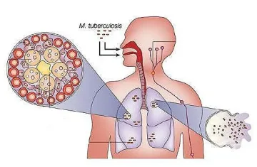 Коронавирусът връща туберкулозата