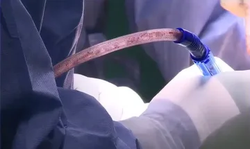 Жена избухна в пламъци по време на операция