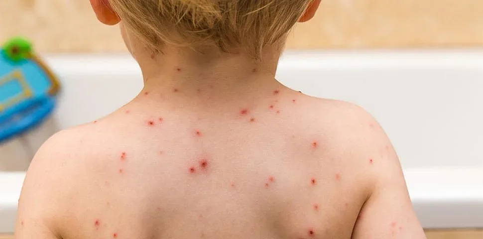 Варицела вилнее посред лято