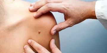 Преглеждаха безплатно за рак на кожата в Кърджали