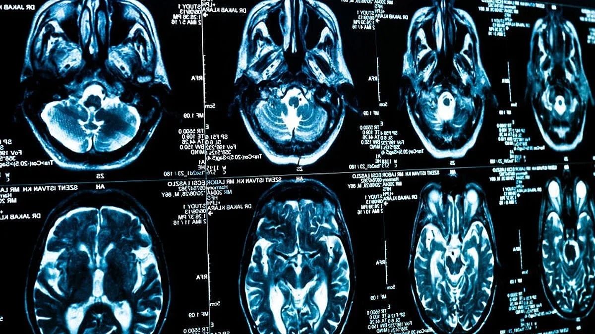 Създадоха суперлекарство - вдига на крака пациенти след инсулт!