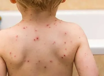 Петте деца с морбили от Разлог са стабилизирани