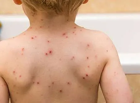 Петте деца с морбили от Разлог са стабилизирани