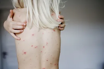 Расте броят на учениците със сифилис