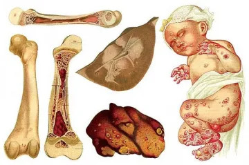 Сифилисът имитира други болести
