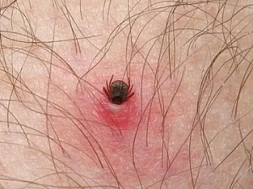 Първи случай на ку-треска в Пловдив