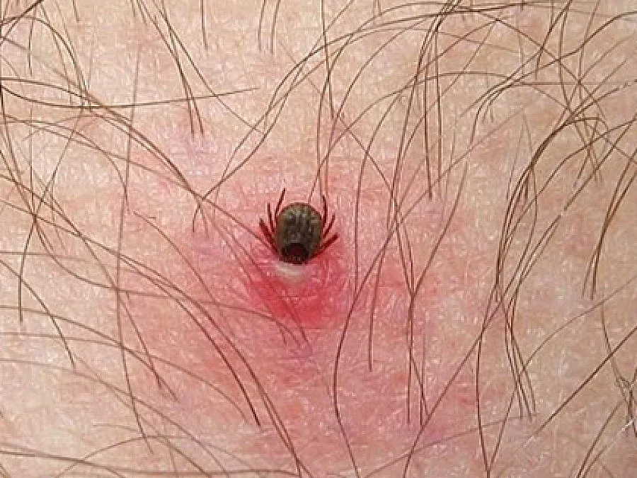 Първи случай на ку-треска в Пловдив