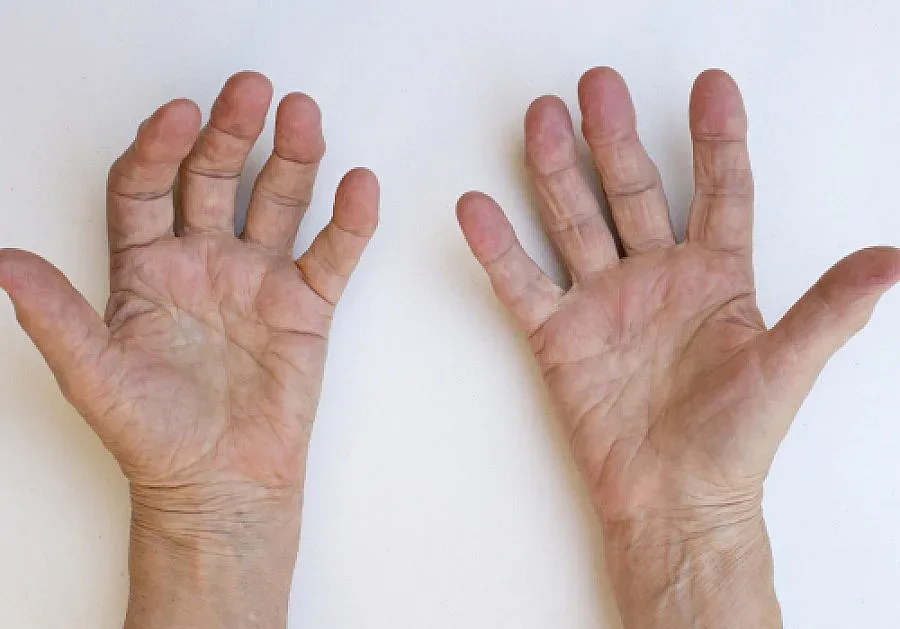 60 хил. са българите с ревматоиден артрит