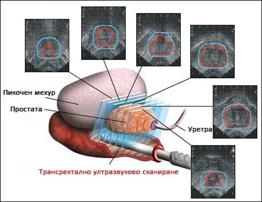 Три ключови ползи от лазерната хирургия на простатата с Тулиум 200 вата