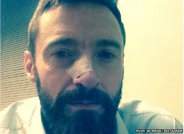 Хю Джакман отново се лекува от рак