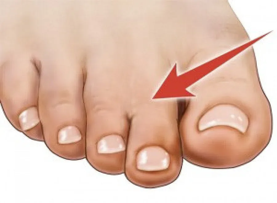 По пръстите на краката ще ги познаете