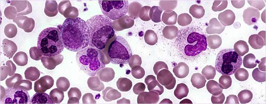 Вълшебният куршум се цели по-точно в рака