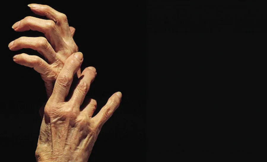 На опашката сме по лечение на ревматични болести