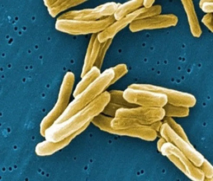 27% по-висока заболеваемост от туберкулоза в Сливенско