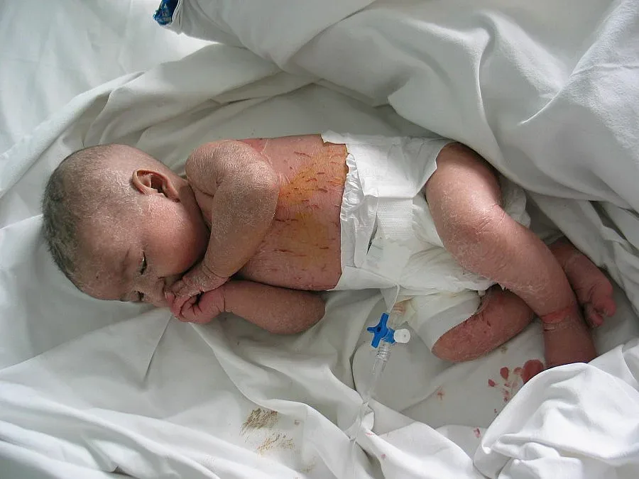 Кърмаче бере душа, майката му осолявала кожата