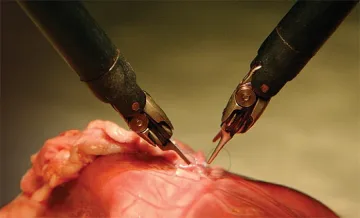 Махат рак през 1 см разрез