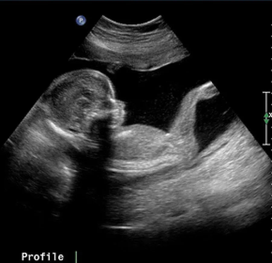 40 000 БГ жени се нуждаят от донорство, за да бъдат майки