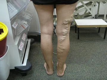 Лекуват вени с едно боцване