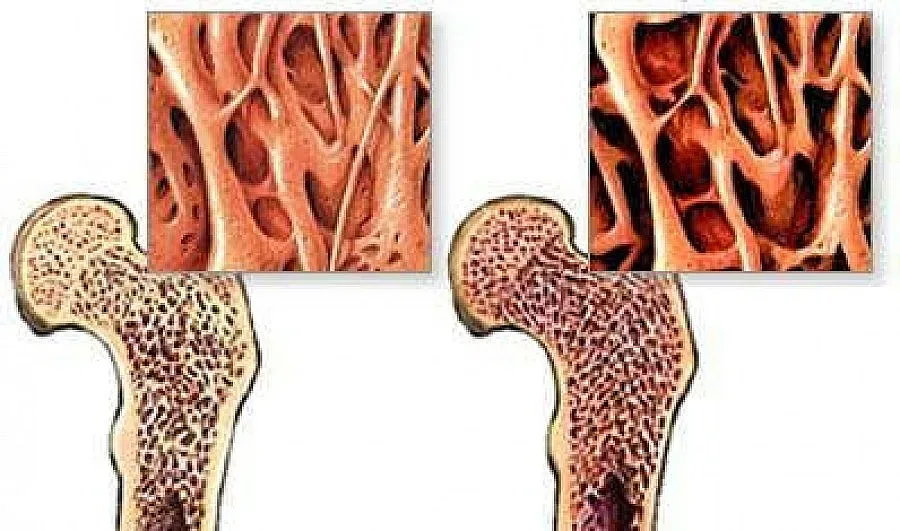 Oтбелязват Световния ден за борба с остеопорозата