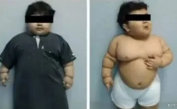 Оперираха 2-годишно дете, което тежи 33 кг.