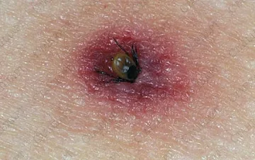 Кърлежи докараха лаймска болест