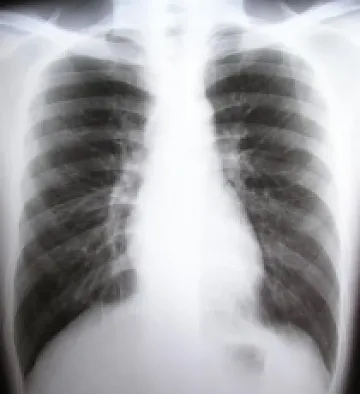 Половин милион българи са с белодробна болест