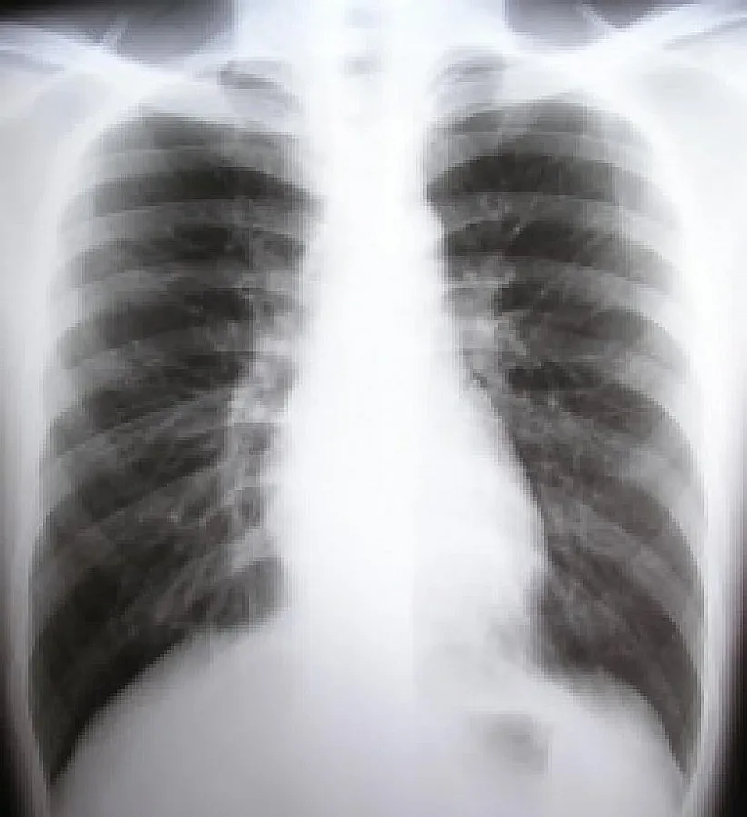 Половин милион българи са с белодробна болест