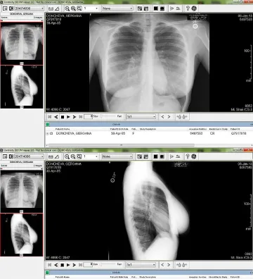 Гери показа балкона на рентген