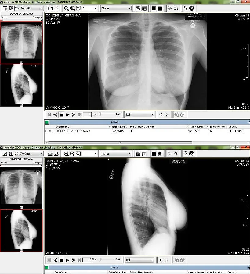 Гери показа балкона на рентген