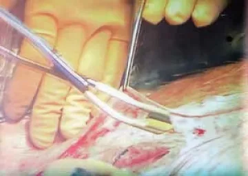 Операция спаси гръбнака на 150 кг пациент