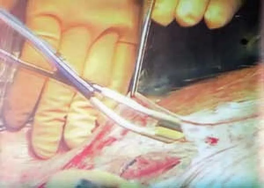 Операция спаси гръбнака на 150 кг пациент