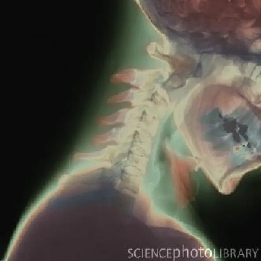 Британец живял 40 години със счупен врат