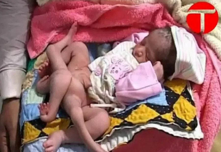 Наша болница готова да оперира бебе с 6 крачета