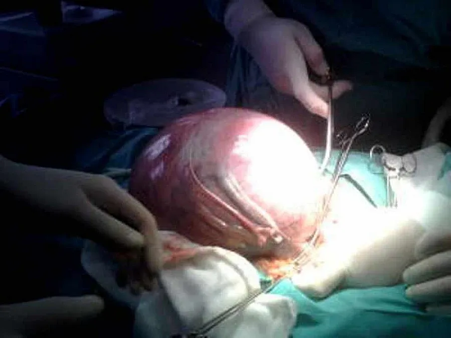 Извадиха 8-килограмов тумор от баба в Перник