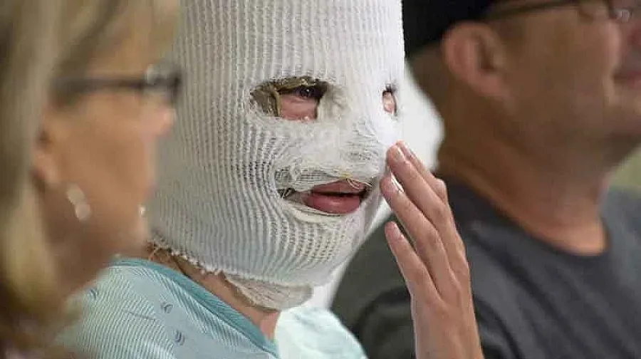 26 жени обезобразени с киселина за година