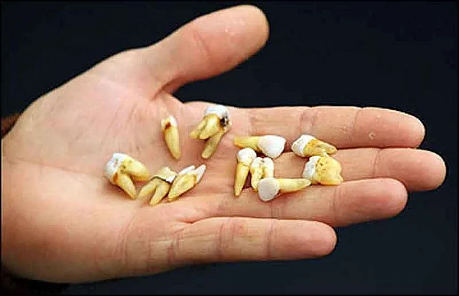 Извадили над 10 хиляди зъба на хлапета за година