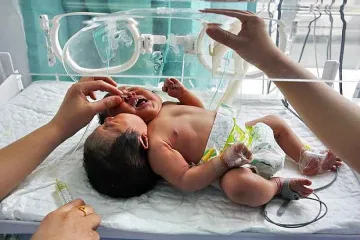 Умря китайското момиченце с две глави