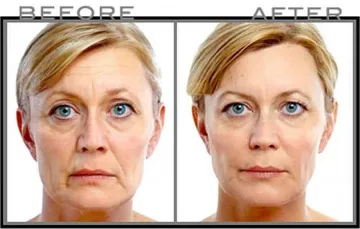 Хапче опъва бръчките