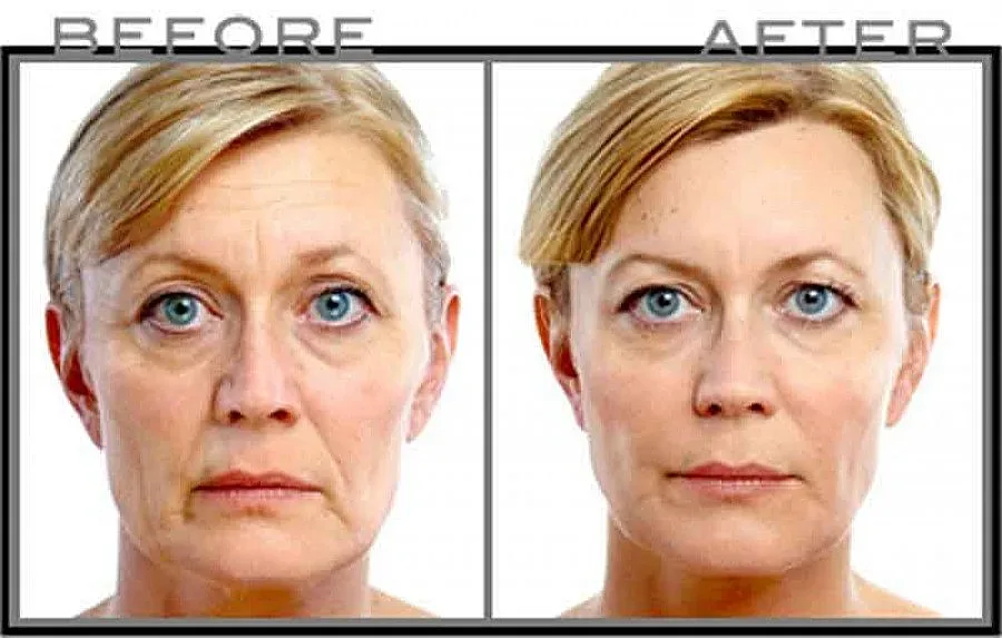 Хапче опъва бръчките