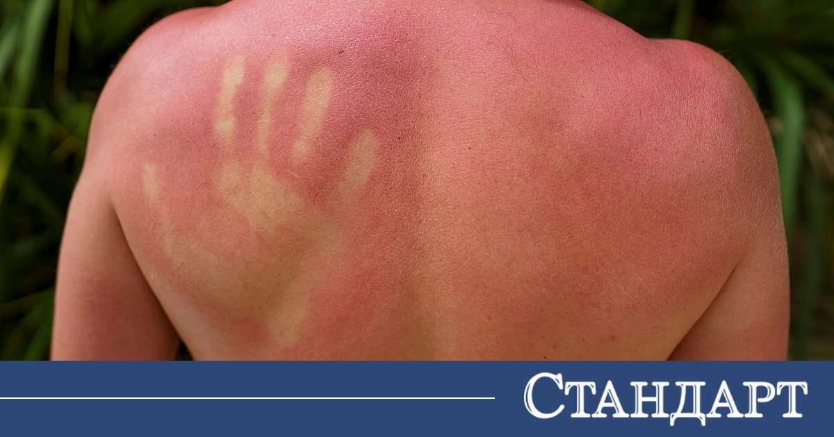Пробив в науката! Разкриха истинската причина за слънчевото изгаряне