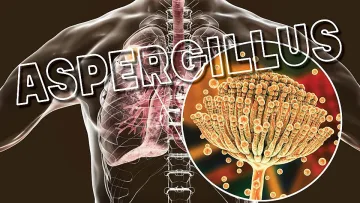 Плесента разболява белите дробове