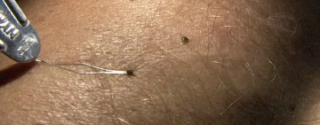 Колко струва да ти махнат кърлеж в болница